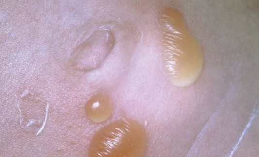 What is impetigo (膿瘡病)? -- Yeung Ho Hong, 楊浩康